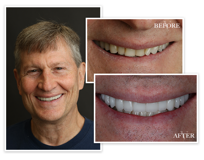 smile-gallery-collage-2 Before and After collage of Patient 2