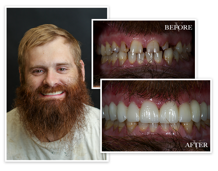 smile-gallery-collage-3 Before and After collage of Patient 3