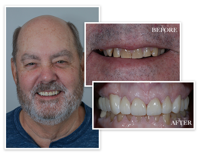 smile-gallery-collage-7 Smile Gallery Collage Patient 7