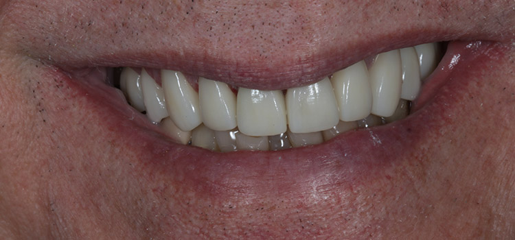 smile-gallery-slider-3-after