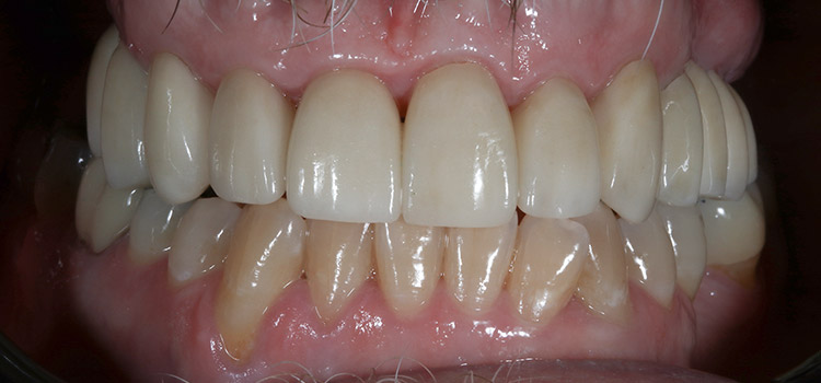 smile-gallery-slider-4-after