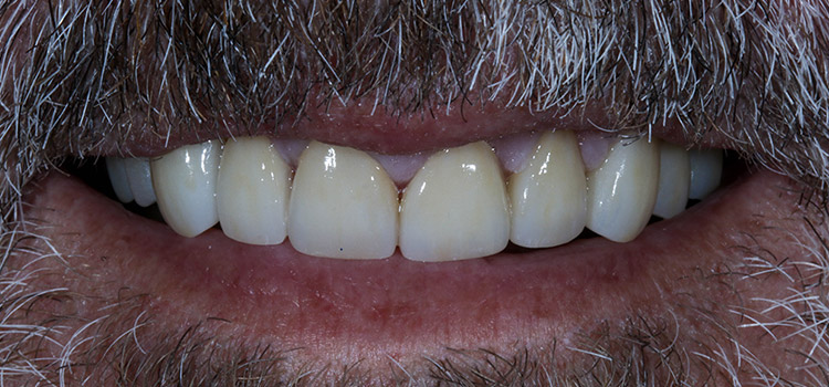 AFTER AFTER
