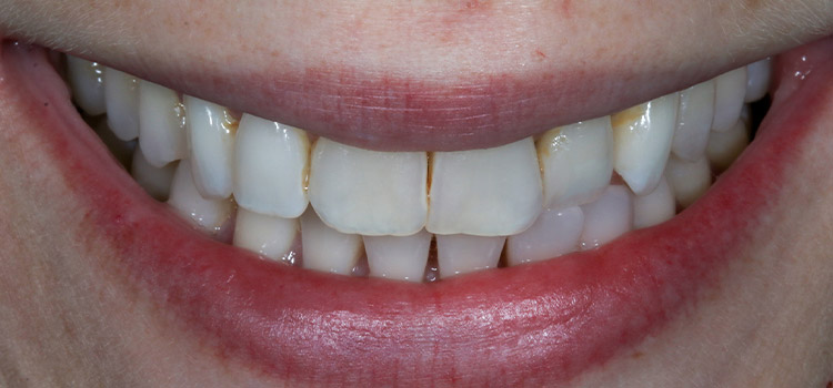 BEFORE BEFORE